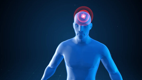 Модель человека с импульсами головной боли, медицинская концепция
