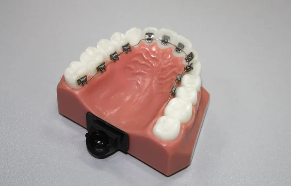 Lingual Braces Model — Stock Photo, Image