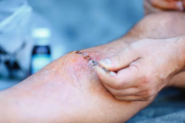 Tratamiento de la herida en la pierna del hombre con yodo — Foto de Stock
