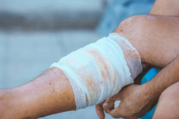 Process of applying a bandage on the injured leg — Stock Photo, Image