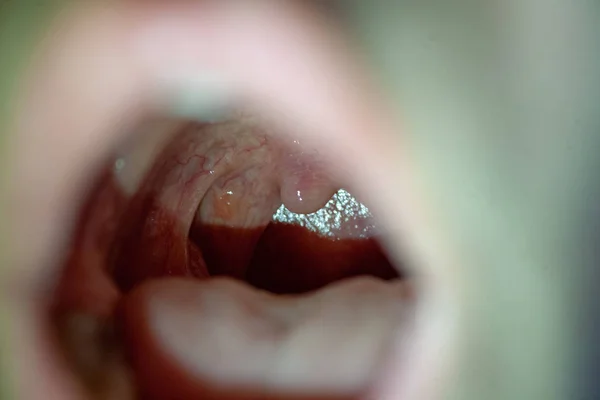 Sore throat closeup view inside mouth — Stock Photo, Image