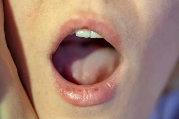 Боль в горле вид вблизи рта — стоковое фото