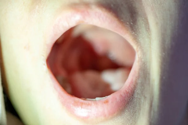 Dolor de garganta vista de cerca dentro de la boca — Foto de Stock