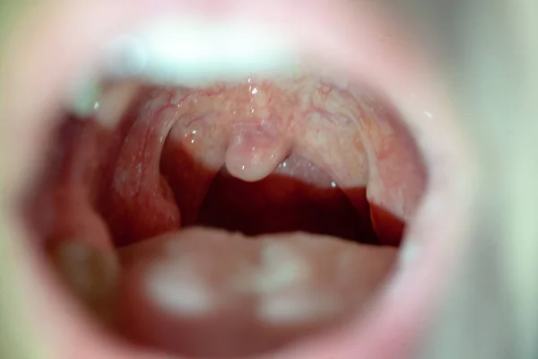 Mal de gorge vue rapprochée à l'intérieur de la bouche — Photo
