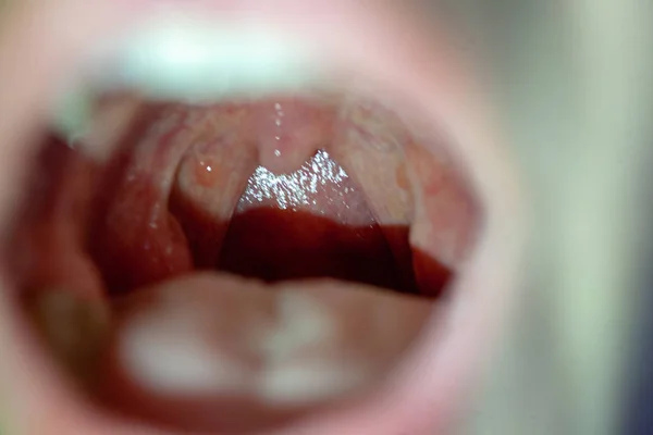 Dolor de garganta vista de cerca dentro de la boca —  Fotos de Stock
