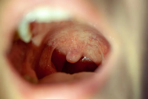 Ból gardła zbliżenie Widok wewnątrz usta — Zdjęcie stockowe