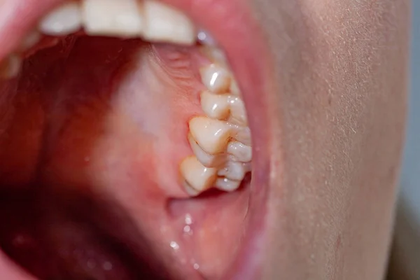 Relleno temporal de un paciente con caries dental — Foto de Stock