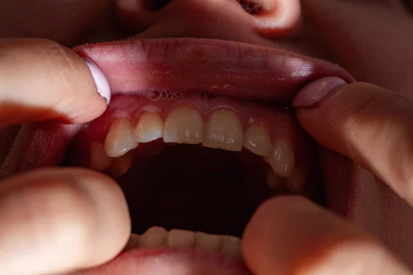 Remplissage temporaire d'un patient atteint de carie dentaire — Photo