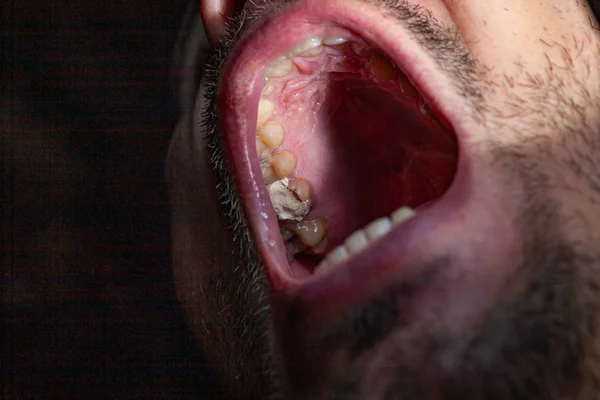 Тимчасове заповнення зуба карієсом пацієнта — стокове фото