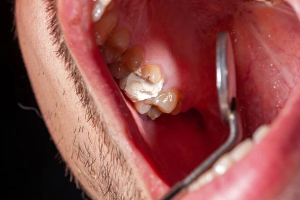 歯齲齲病患者の一時的な充填 — ストック写真