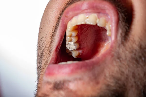 Tillfällig fyllning av en tand karies patient — Stockfoto