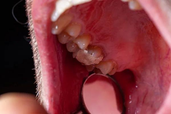 Relleno temporal de un paciente con caries dental — Foto de Stock