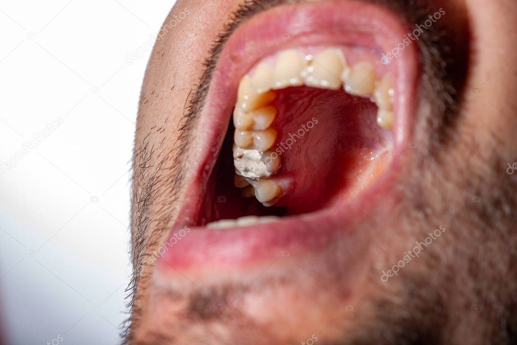 temporary filling of a tooth caries patient