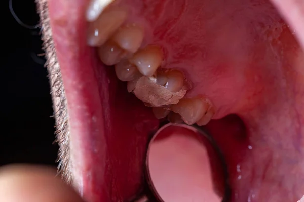 歯齲齲病患者の一時的な充填 — ストック写真