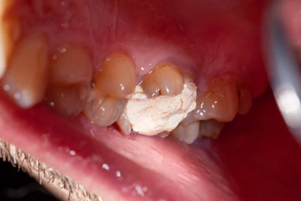 Temporary filling of a tooth caries patient — Stock Photo, Image