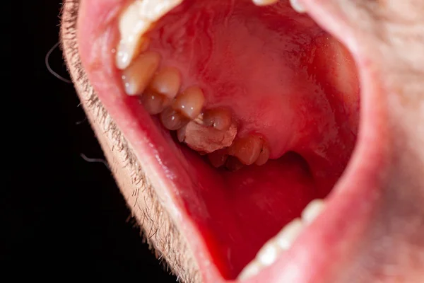 Relleno temporal de un paciente con caries dental — Foto de Stock