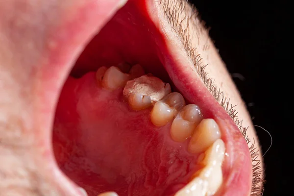 Relleno temporal de un paciente con caries dental — Foto de Stock