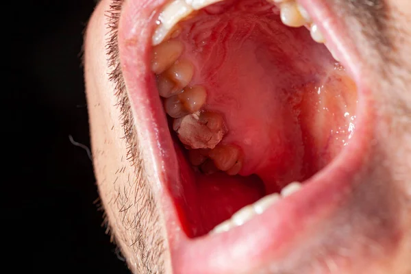치아 우치 환자의 임시 충전 — 스톡 사진