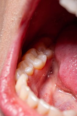 bir diş çürüme hastanın geçici doldurma