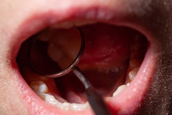 Dočasné plnění pacienta se zubním kartáčem — Stock fotografie
