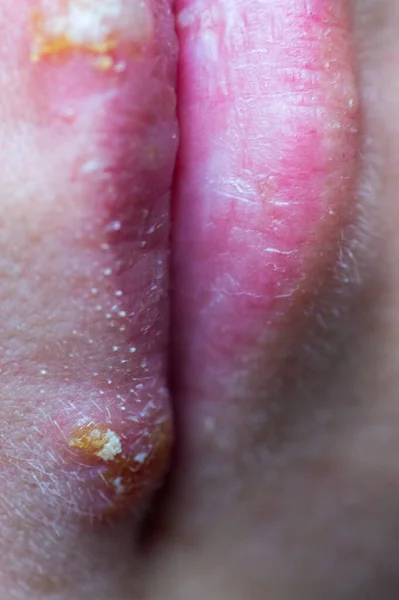 Herpes Krankheit Auf Den Lippen Eines Jungen Mädchens Wunden Von — Stockfoto
