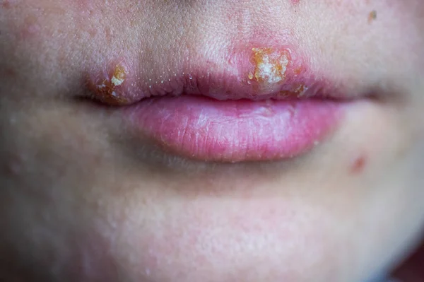 Genç bir kızın dudaklarında uçuk hastalığı. Bir insanın dudaklarındaki uçuktan kaynaklanan yaralar. Herpes foci.