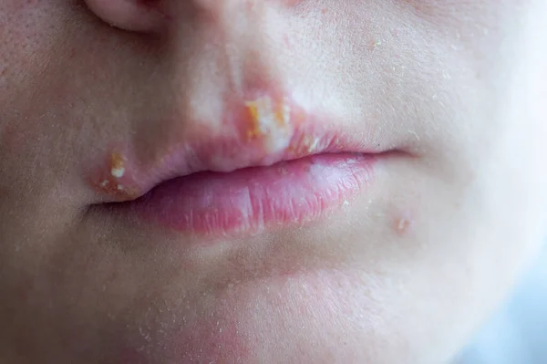 Herpes disease on the lips of a young girl — Stock Photo, Image