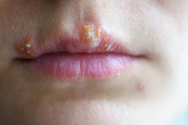 Enfermedad del herpes en los labios de una niña — Foto de Stock