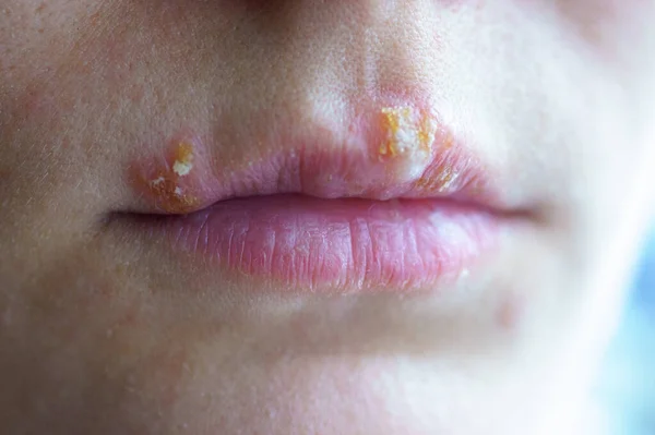 Enfermedad del herpes en los labios de una niña — Foto de Stock