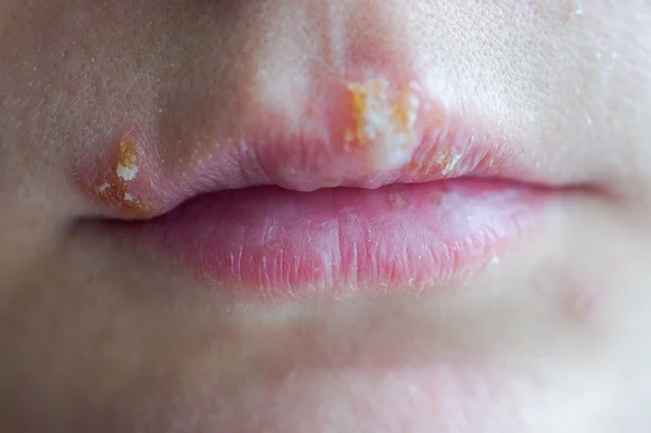 Enfermedad del herpes en los labios de una niña — Foto de Stock