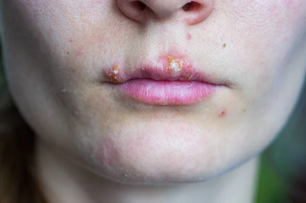 Enfermedad del herpes en los labios de una niña — Foto de Stock