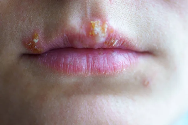 Enfermedad del herpes en los labios de una niña — Foto de Stock