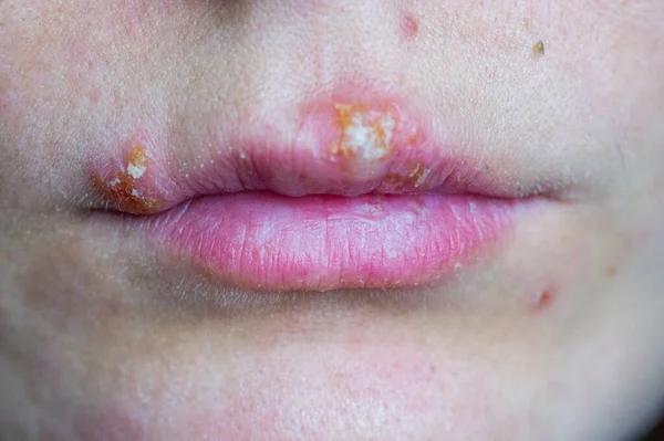 Enfermedad del herpes en los labios de una niña — Foto de Stock