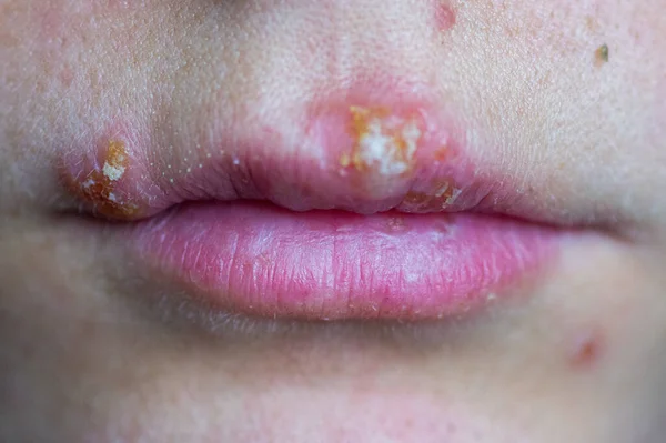 Enfermedad del herpes en los labios de una niña — Foto de Stock