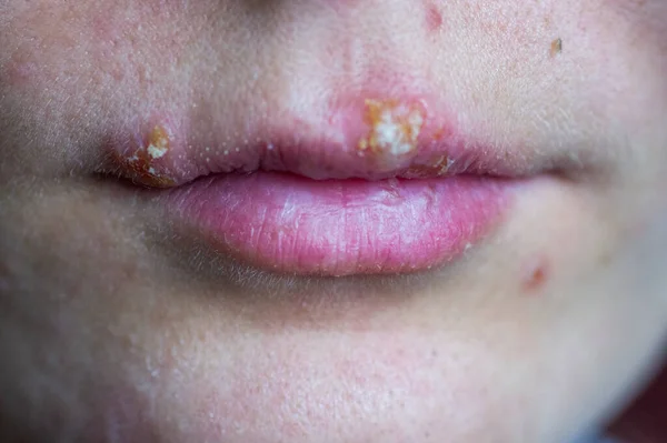 Malattia da herpes sulle labbra di una giovane ragazza Immagine Stock