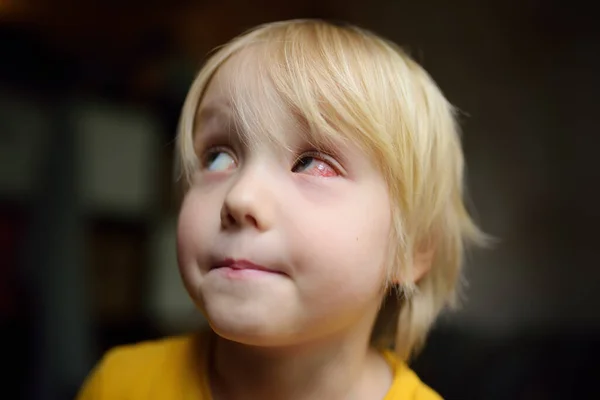 Preschooler Boy Red Bursted Blood Vessels Eye Conjunctivitis Trauma Eye — Stock Photo, Image