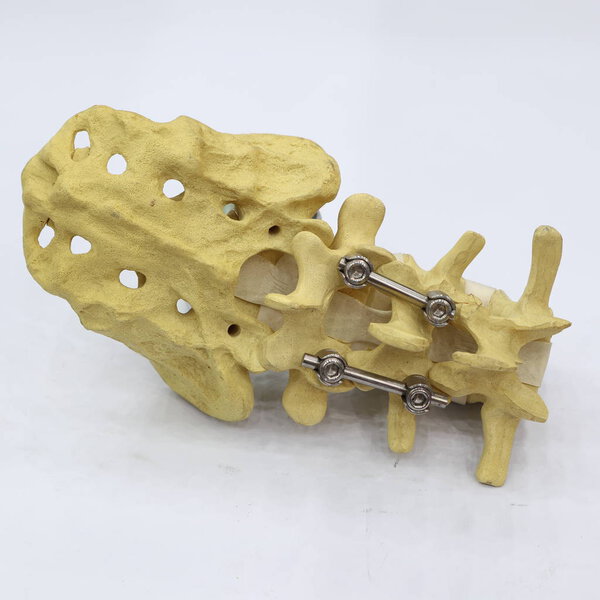 Система фиксации позвоночника - титановая скобка; крупным планом
