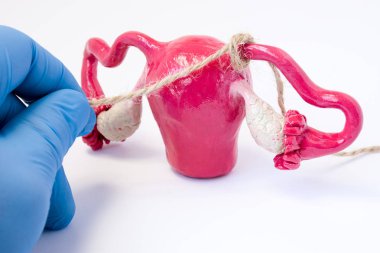 Tubal ligasyon veya cerrahi müdahale tubectomy operatif kadın hastalıkları kavramı fotoğraf. Doktor kadın cinsel organlar rahim ve yumurtalıklar ip modeli fallop tüpleri ile bağlar. Cerrahi Sterilizasyon