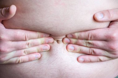 İnsan elleri yakınındaki göbek karın karın yakın çekim ortasında şiddetli ağrı yerelleştirilmesini gösteren koymak. Akut pankreatit, pankreas ve bağırsak güçlü çevre acı belirtisi