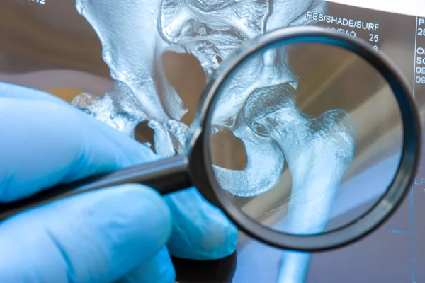 Doctor Examines Mri Snapshot Hip Joint Magnifying Glass Careful Diagnosis — Stock Photo, Image