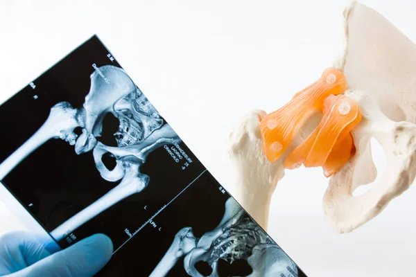 Physician, intern or student of medical university holds in his hand MRI (CT) scans of hip joint, comparing it with anatomical model of hip joint, located little further (focusing on model)