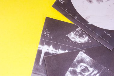 Yukarıdan sarı tek tip arka plan görünüm muayenede ultasound sonucu yarım fotoğraf Etiketler, başlıklar için açık alana sahip. Konsept Fotoğraf sonogram yordam, ultrason tarafından tanı için 