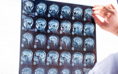 Beyin MR'ı ile incelenmesi. Hastaların acil sipariş taramaları taze anlık görüntü Doktor Röntgen görüntüleme kutusunu kullanarak ve hematom, tümör, travma veya travmatik ihlal için el ile tutarak MRI beyin 