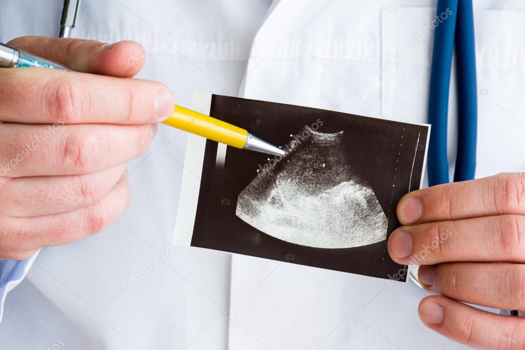 Hematoma of spleen on ultrasound image concept photo. Doctor indicating by pen on printed picture ultrasound pathology -  splenic hematoma. Photo for diagnosis, radiology, surgery, traumatology