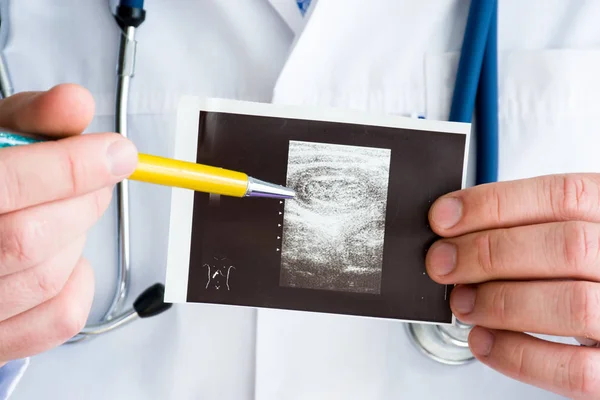 Intussuscepção Intestino Flexão Hepática Cólon Imagem Ultra Sonográfica Foto Conceito — Fotografia de Stock