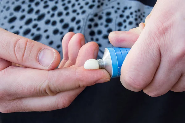 Patient Squeezes Out Aluminum Tubes Ointment Medicinal Substance Finger Photo — Stock Photo, Image