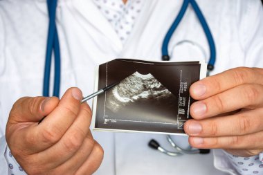 Ultrason görüntülü fotoğrafta böbrek tümörü ya da diğer onkolojiler. Doktor, basılı resim ultrasonunda böbrek tümöründe patoloji lezyonu olduğunu belirtiyor. Teşhis, radyoloji, nefroloji için.