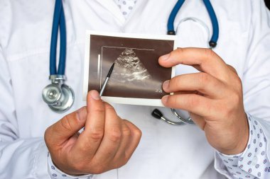 Ultrason fotoğrafında polisistik böbrek hastalığı. Doktor, böbreklerdeki birçok kistin ultrason patolojisinin basılı resmine işaret ediyor. Teşhis, radyoloji, nefroloji için.