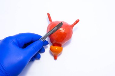 Beyaz arka planda, prostatlı mesanenin tıbbi maketi ve organının üstünde neşter olan cerrahın eli var. İdrar kesesinde tıkanıklık veya idrar tutamama için cerrahi müdahalenin fotoğrafı fikri
