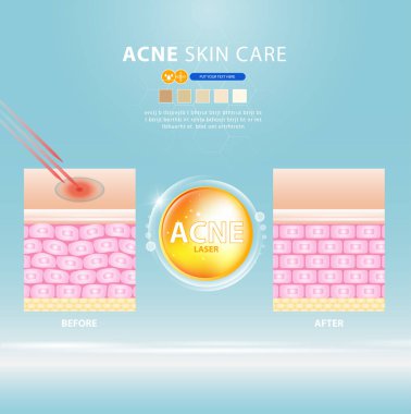 sivilce lekesi sorunlu vektör tasarımı.